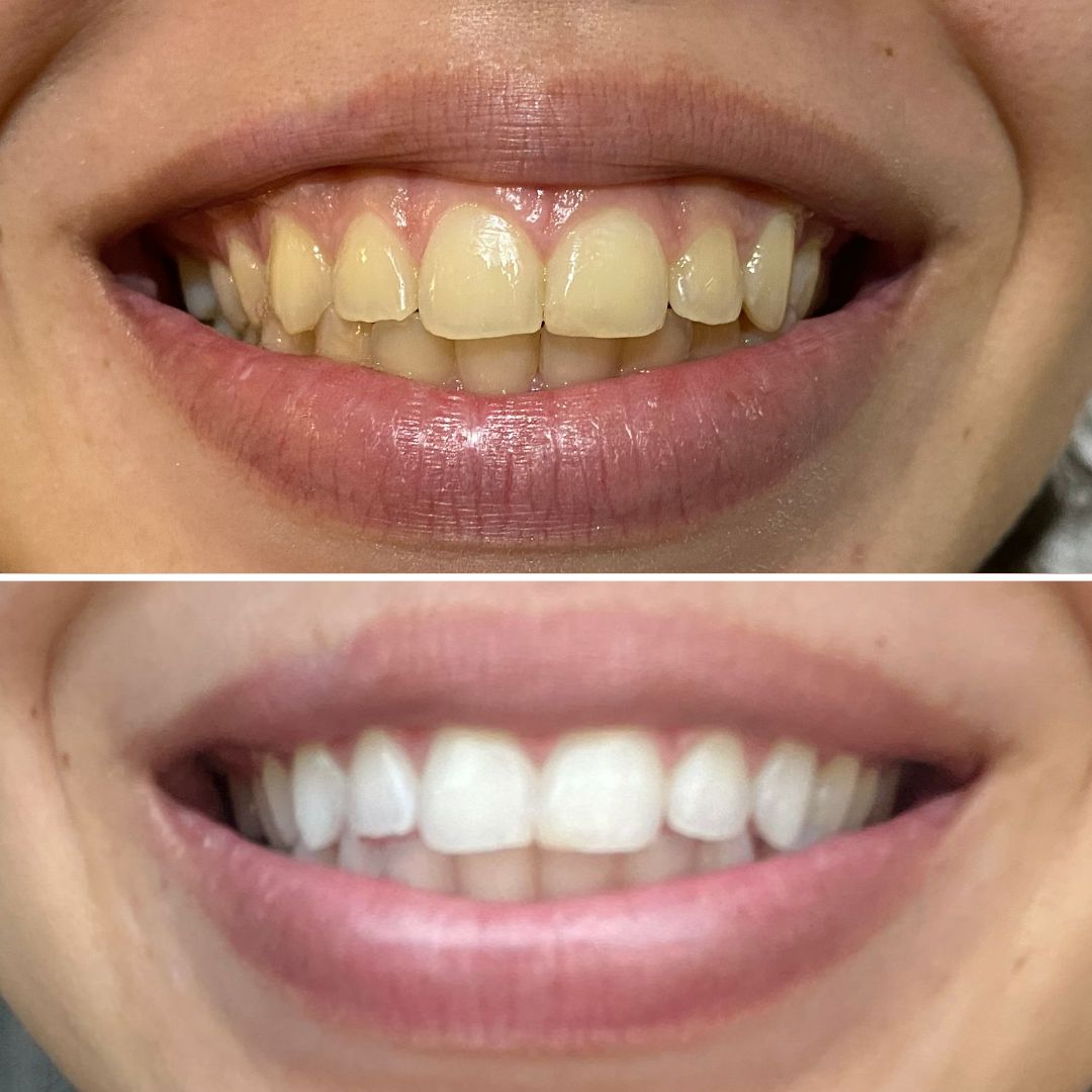 Antes e Depois Limpeza