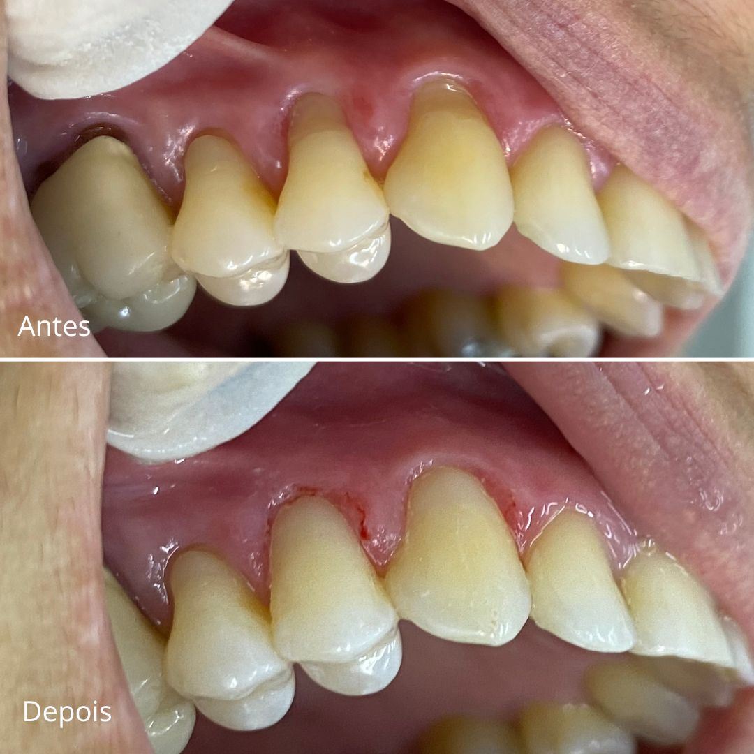 Antes e Depois Clareamento